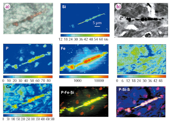 Micro-XRF and X-ray microscopy of lung tissue containing asbestos