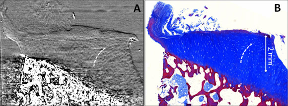 ABI-CT of osteoarthritic cartilage